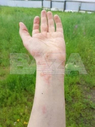 Обожжённые руки и лицо вместо шашлыков — жительница Читы получила увечья из-за взрыва бутылки с жидкостью для розжига Обожжённые руки и лицо вместо шашлыков — жительница Читы получила увечья из-за взрыва бутылки с жидкостью для розжига