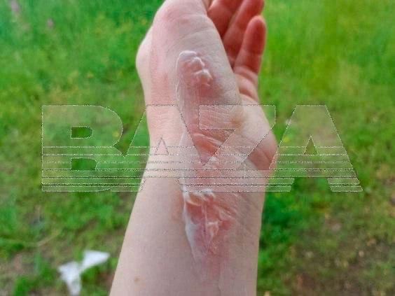 Обожжённые руки и лицо вместо шашлыков — жительница Читы получила увечья из-за взрыва бутылки с жидкостью для розжига Обожжённые руки и лицо вместо шашлыков — жительница Читы получила увечья из-за взрыва бутылки с жидкостью для розжига